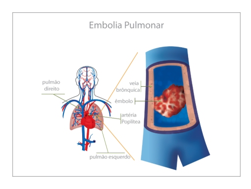 embolia-pulmonar1
